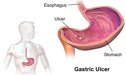 gastric problems